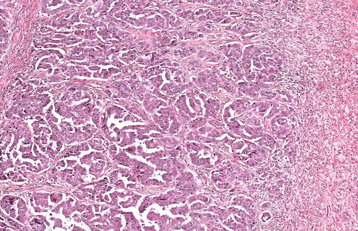 GREAT : Etude des anomalies génomiques et moléculaires dans le cancer de l’ovaire