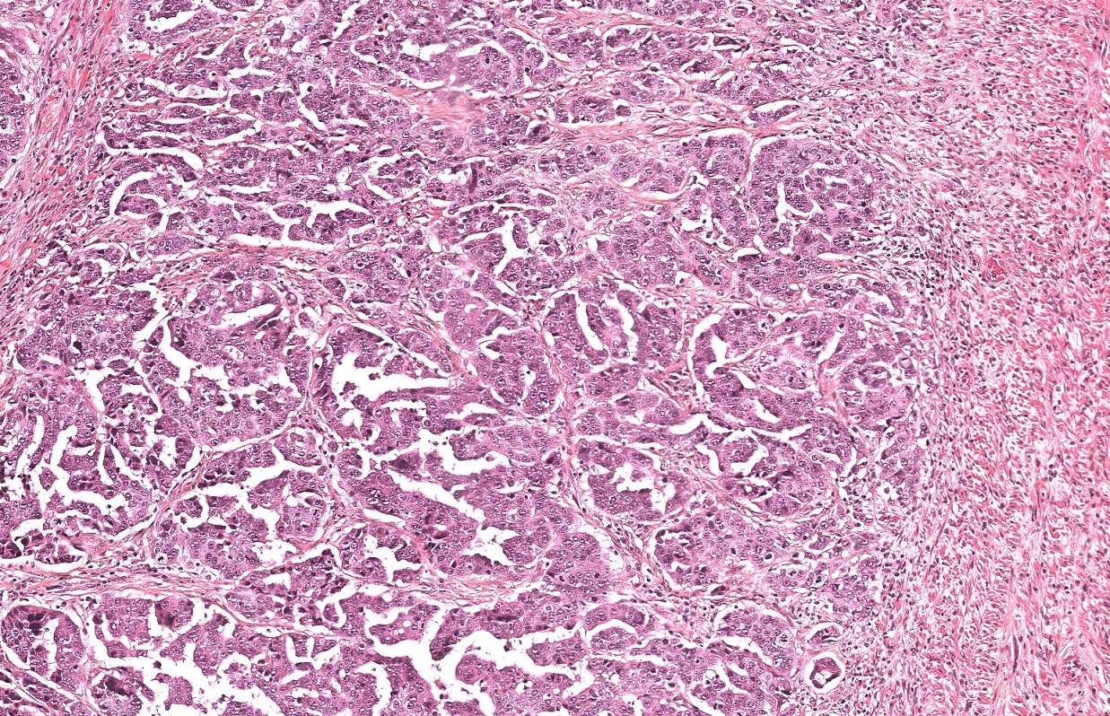 GREAT : Etude des anomalies génomiques et moléculaires dans le cancer de l’ovaire